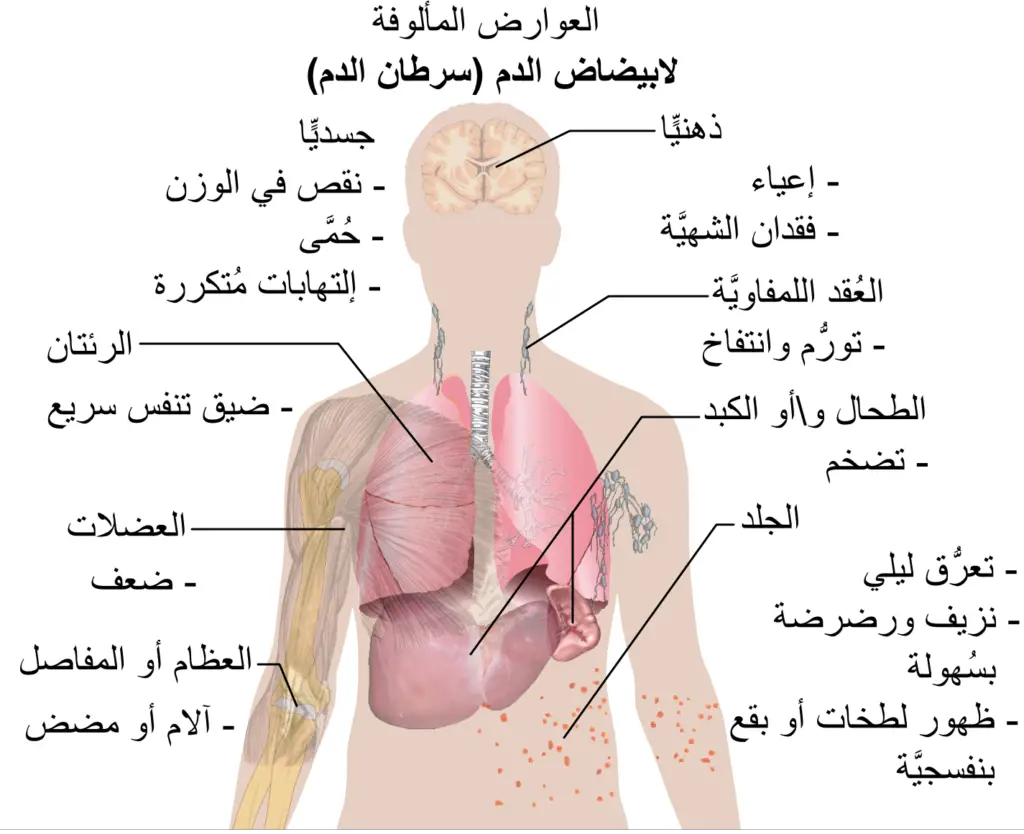 أعراض سرطان الدم
