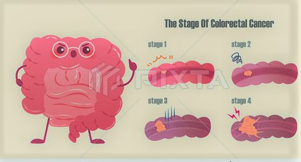 مراحل سرطان القولون
