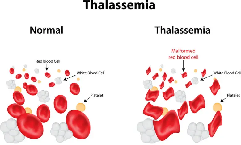 Photo of الثلاسيميا… انواعها واسبابها و 4 طرق لعلاجها