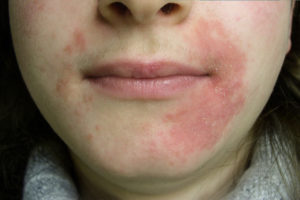 اضطرابات جلدية شائعة.. التهاب الجلد حول الفم