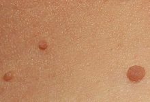 Photo of الزوائد الجلدية… 6 من عوامل الخطر وطرق العلاج