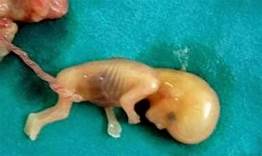 Photo of الإجهاض Miscarriage￼