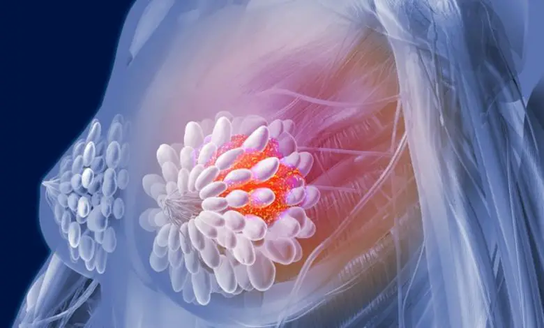 Photo of سرطان الثدي..أسبابه وأعراضه و 3 طرق للعلاج