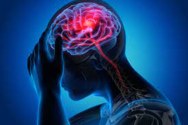 الصداع النصفي أو الشقيقة (Migraine) هو نوع من الصداع يتميز بهجمات متكررة من الآلام النبضية -غالباً- على جانب واحد من الرأس وتؤثر أولاً على العين، تستمر من أربع ساعات إلى ثلاثة أيام حسب العلاج الذي تلقاه المريض. غالباً ما يمر الصداع النصفي بأربع مراحل وهم: البادرة، الأورا، النوبة، ما بعد النوبة أو الانتهاء.